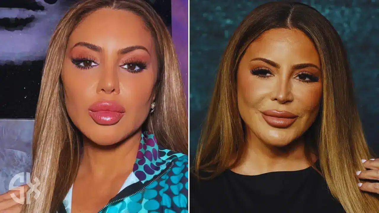 Larsa Pippen face transformation after PRP treatment and allergic reaction claim.